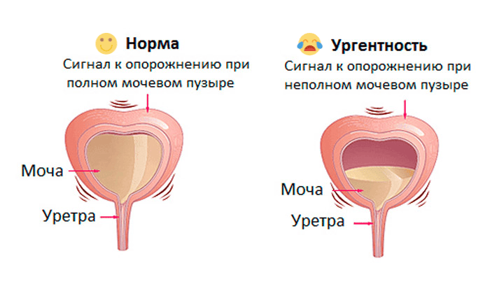 ургентне нетримання сечі
